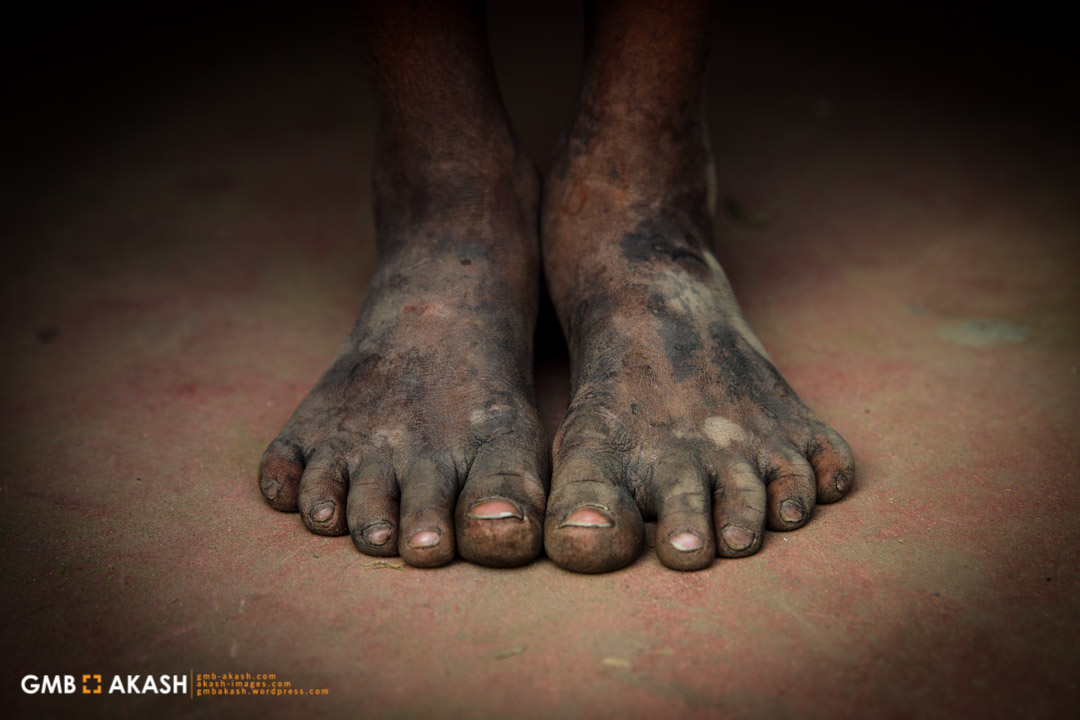 sami hamja 10, mother died ,  father is a heroin addict